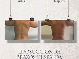 Liposucción antes y después - 870733