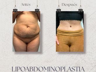 Abdominoplastia antes y después - 870734