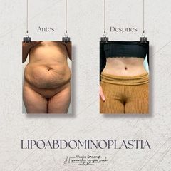 Abdominoplastia - Dra. Maria Antonia Hernández Sepúlveda