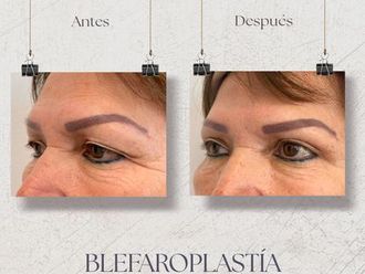 Blefaroplastia antes y después - 870736