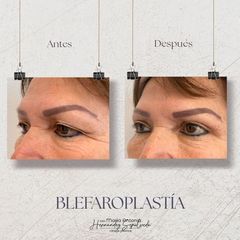 Blefaroplastia - Dra. Maria Antonia Hernández Sepúlveda