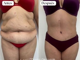 Abdominoplastia antes y después - 870738