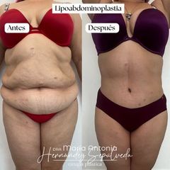 Abdominoplastia - Dra. Maria Antonia Hernández Sepúlveda