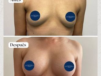 Aumento de busto antes y después - 870742