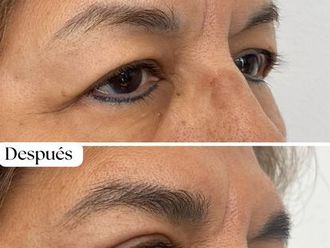 Blefaroplastia antes y después - 870744