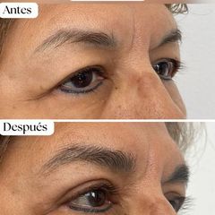 Blefaroplastia - Dra. Maria Antonia Hernández Sepúlveda