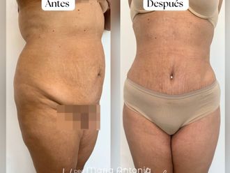 Abdominoplastia antes y después - 870745