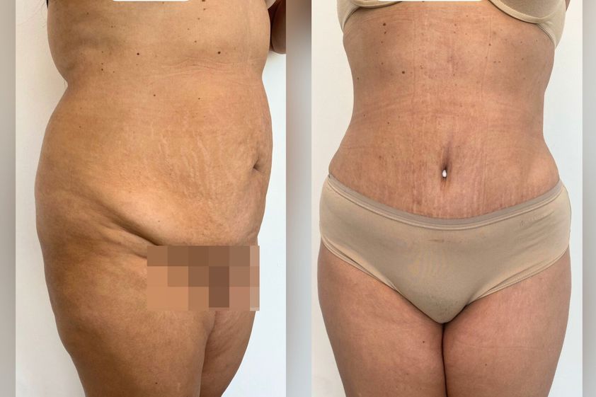Abdominoplastia antes y después - 870745