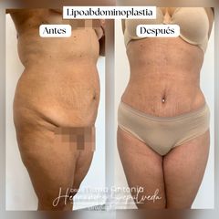 Lipoabdominoplastia - Dra. Maria Antonia Hernández Sepúlveda