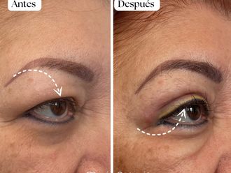 Blefaroplastia antes y después - 870746