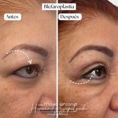 Blefaroplastia - Dra. Maria Antonia Hernández Sepúlveda