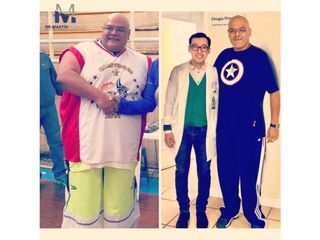 Antes y después de Liposucción