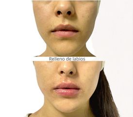 Aumento de labios - Dra. Elena Alvarez Velázquez