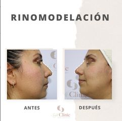 Rinomodelación - Dra. Elena Alvarez Velázquez