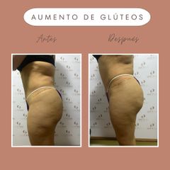 Gluteoplastia - Dra. Elena Alvarez Velázquez