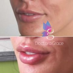 Aumento de labios - Doctora Grace
