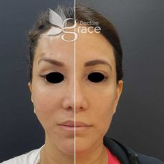 Antes y después de hilos tensores - Doctora Grace