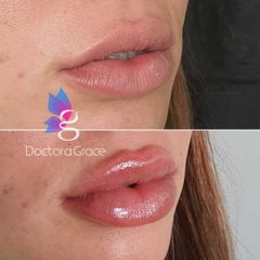 Aumento de labios - BelléMedic