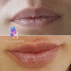 Aumento de labios - BelléMedic