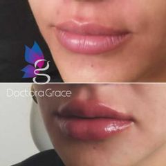 Aumento de labios -Doctora Grace