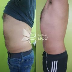 Antes y después de radiofrecuencia - Doctora Grace