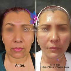 Antes y después de hilos tensores - Doctora Grace