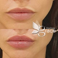 Aumento de labios - BelléMedic