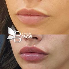 Aumento de labios - Doctora Grace