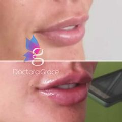 Aumento de labios - BelléMedic