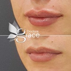 Antes y después de aumento de labios -Doctora Grace
