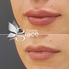 Aumento de labios - BelléMedic