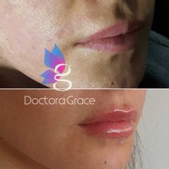 Antes y después de aumento de labios - Doctora Grace