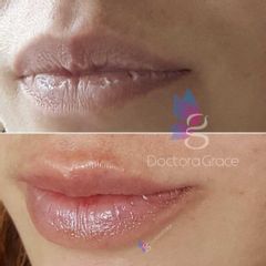 Antes y después de aumento de labios - BelléMedic