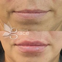Antes y después de aumento de labios - Doctora Grace