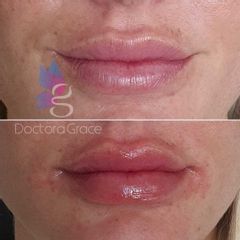Antes y después de aumento de labios - BelléMedic