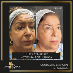 Antes y después de hilos tensores - Doctora Grace