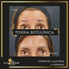 Toxina Botulínica  - Doctora Grace