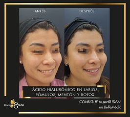 Ácido hialurónico - Doctora Grace