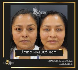 Antes y después de ácido hialurónico - Doctora Grace