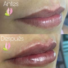 Aumento de labios - Beautytech by Dra. Melisa Chavez