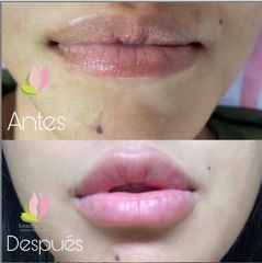 Antes y después de Aumento de labios 