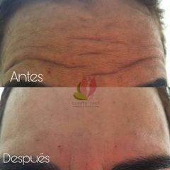 Antes y después de Aplicación de toxina botulínica