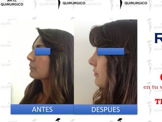 Rinoplastia antes y después - 605002