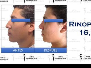 Antes y después de rinoplastia
