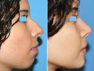 Antes y después de Rinoplastia