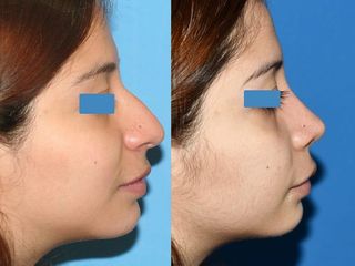 Antes y después de Rinoplastia