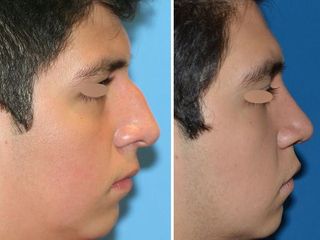 Antes y después de Rinoplastia