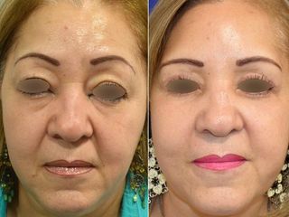 Antes y después de Blefaroplastia