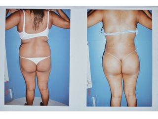 Antes y después de lipoescultura