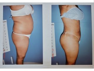 Antes y después de abdominoplastia